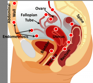 endometriose-ayurveda